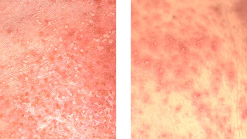 Keeping score: Novel method might help differentiate two serious skin diseases