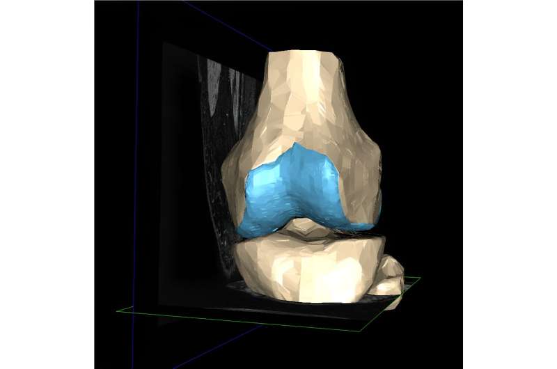 Scientists warn of a 'tsunami' of osteoarthritis cases by 2050