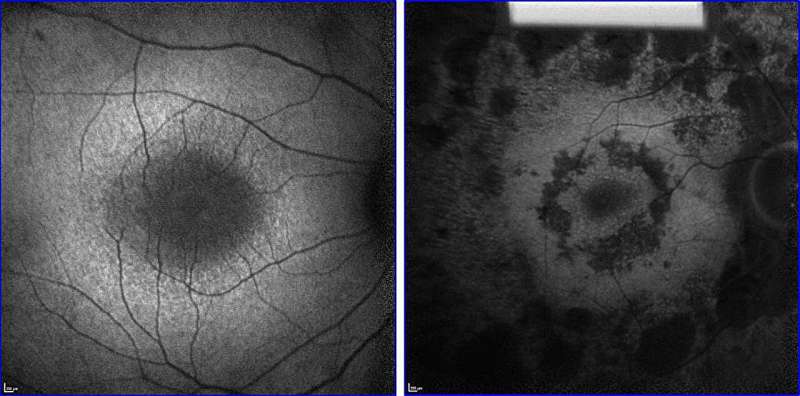 Revitalizing vision: Metabolome rejuvenation can slow retinal degeneration