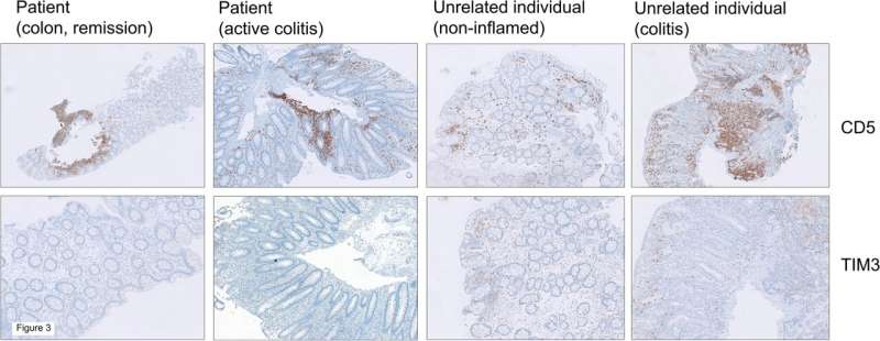 Examining inflammatory bowel disease after a stem cell transplant