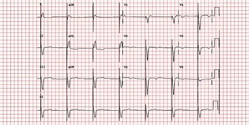 Pacemaker powered by light eliminates need for batteries and allows the heart to function more naturally − new research