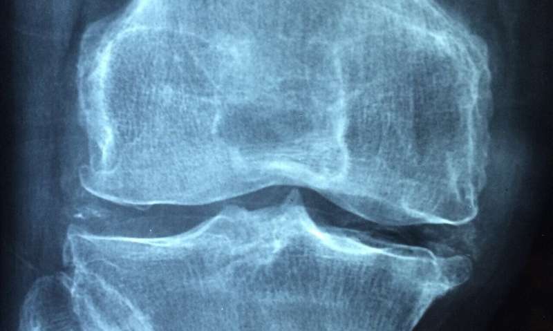 Study upends understanding about joint injuries 