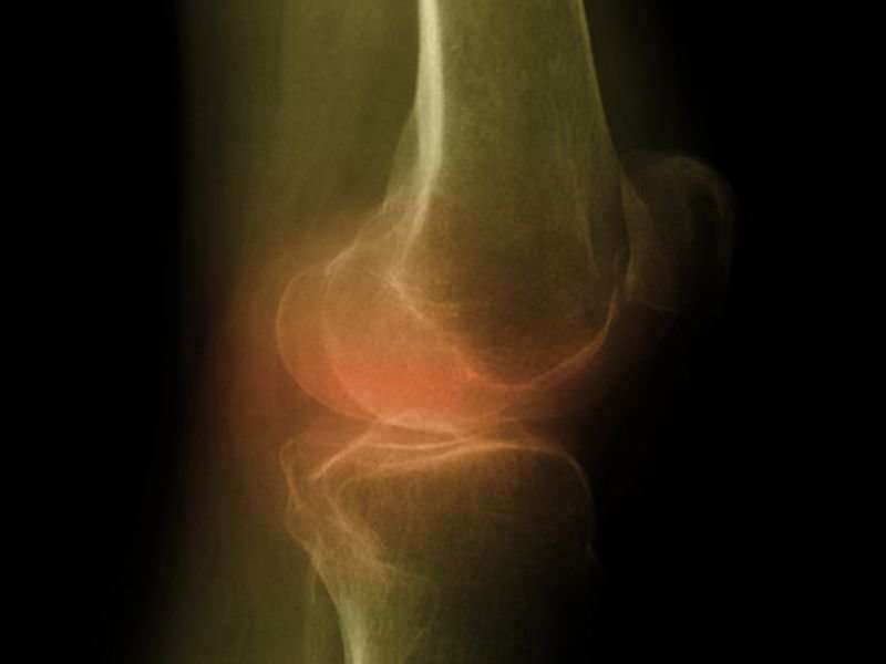 Bariatric surgery lessens knee OA pain more in certain patients