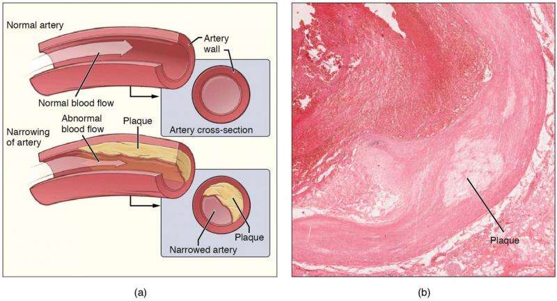 Researchers uncover key therapeutic target involved in diabetic atherosclerosis 