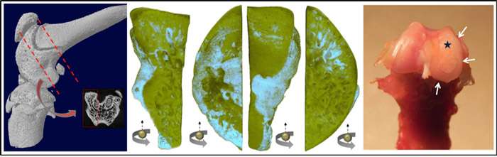 Diagnosing osteoarthritis before it appears