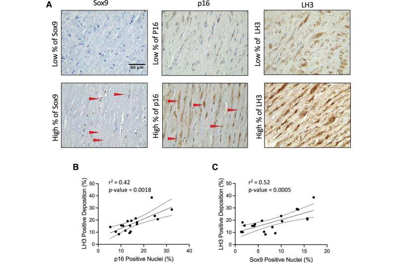 LH3 (procollagen-lysine, 2-oxoglutarate 5-dioxygenase 3) deposition increases in the medial aortic layer with age and Sox9 (SRY-box transcription factor 9) expression. A, Immunohistochemistry of Sox9, p16 (cyclin-dependent kinase inhibitor 2A), and LH3 staining in the aortic medial layer. Positive staining is shown in brown. Red arrows highlight the positive staining of Sox9 and p16. Correlation of LH3 positive staining (%) with ( B) p16 and ( C) Sox9 positive nuclei. Normality was validated via the Shapiro-Wilk test, and correlation was determined via the Pearson test (n=16). Credit: Circulation Research (2024). DOI: 10.1161/CIRCRESAHA.123.323365