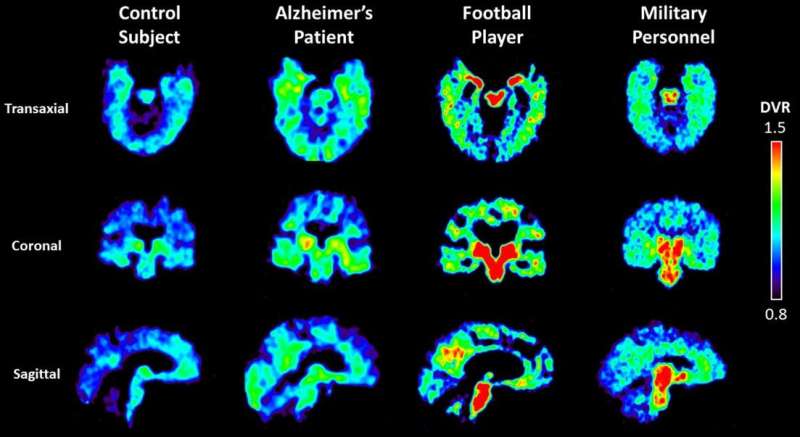 Molecular tracer, seen with PET scan, shows concentrations of abnormal proteins