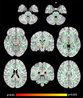 Researchers confirm coeliac disease can damage the brain