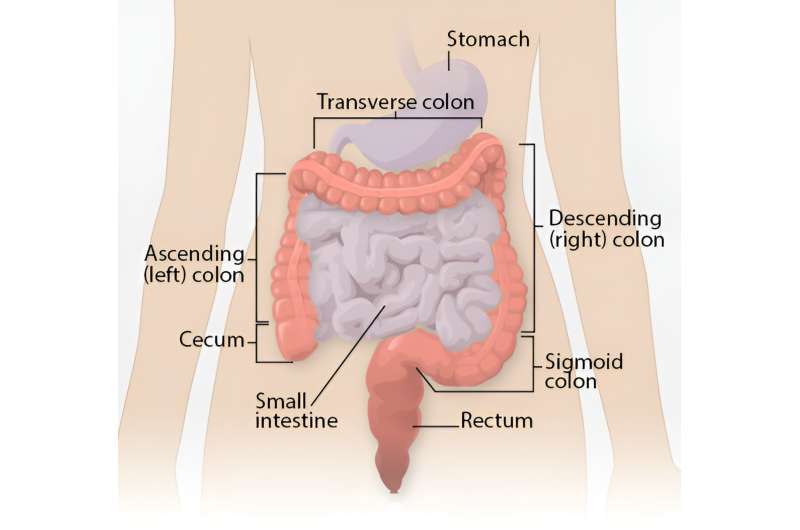 Study reveals colon tumor location matters for metastatic disease 