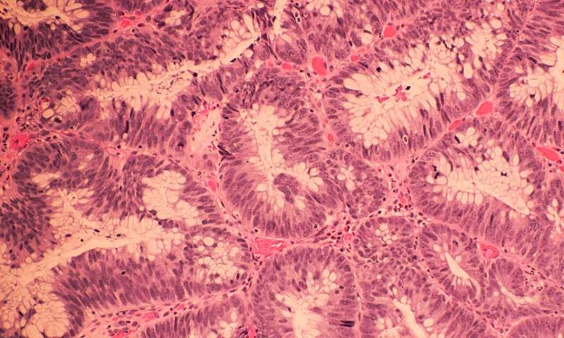 Researchers identify bacterial protein associated with colorectal cancers 