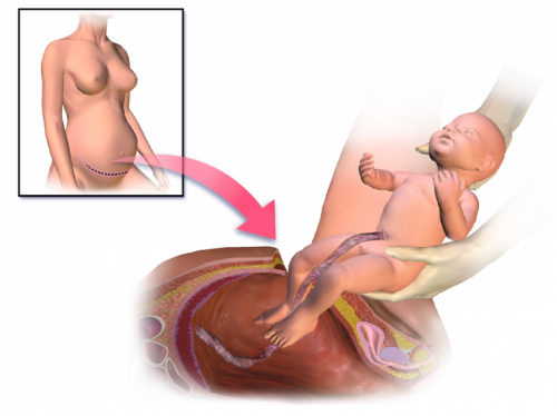 Death rates from cesarean section far higher in developing countries 