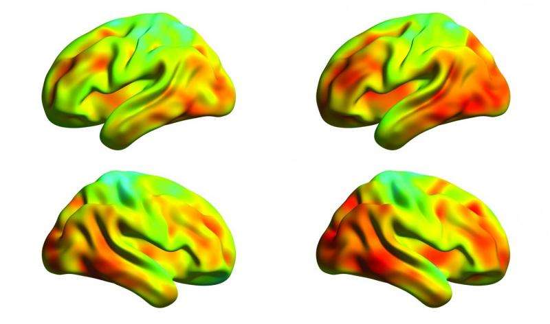 Spread of tau protein measured in the brains of Alzheimer's patients 