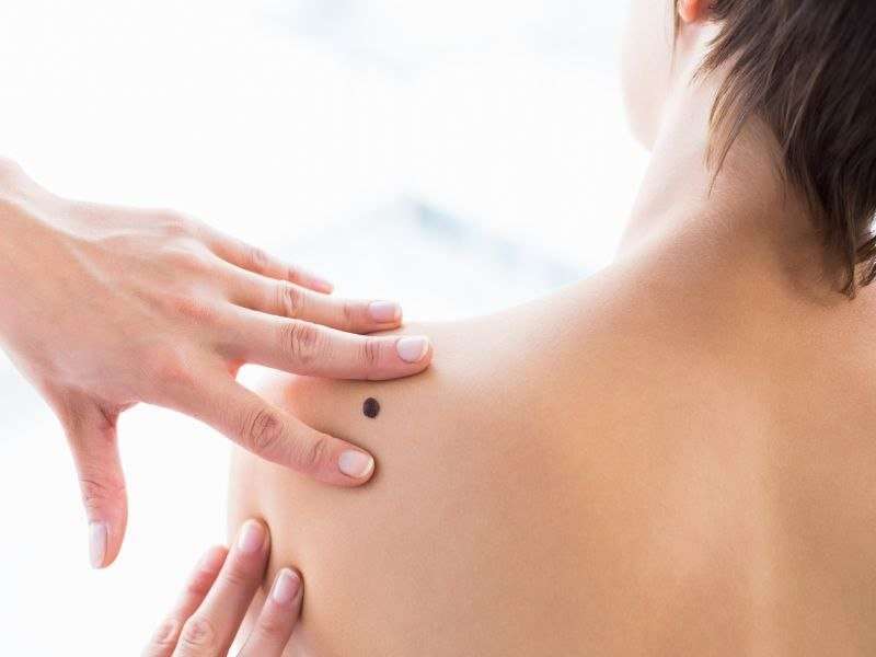 Guidelines of care developed for skin cancer management