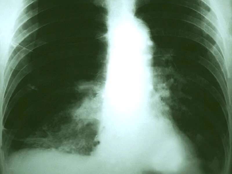 Treatment beneficial for nonagenarians with lung cancer 