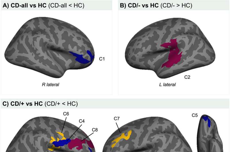 Brain structural differences observed in children with conduct disorder with and without childhood maltreatment 