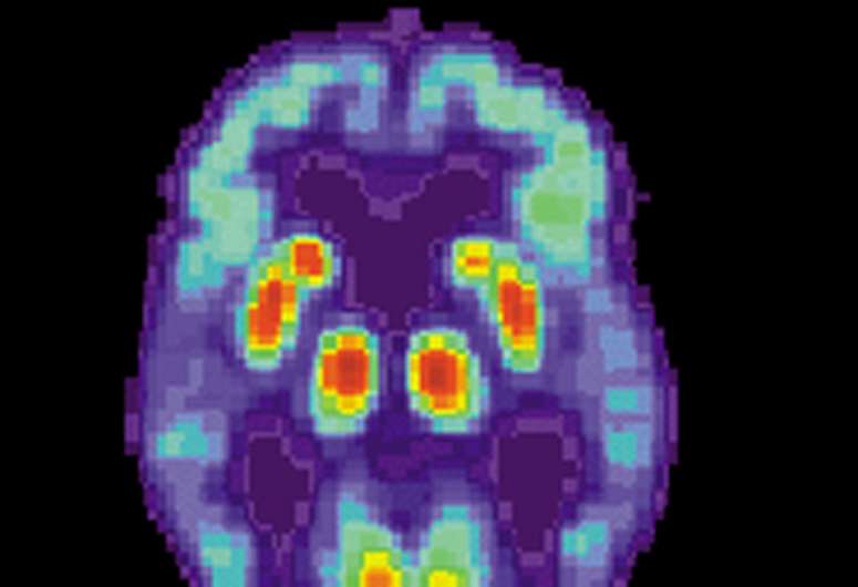 Alzheimer's disease: Neuronal loss very limited 
