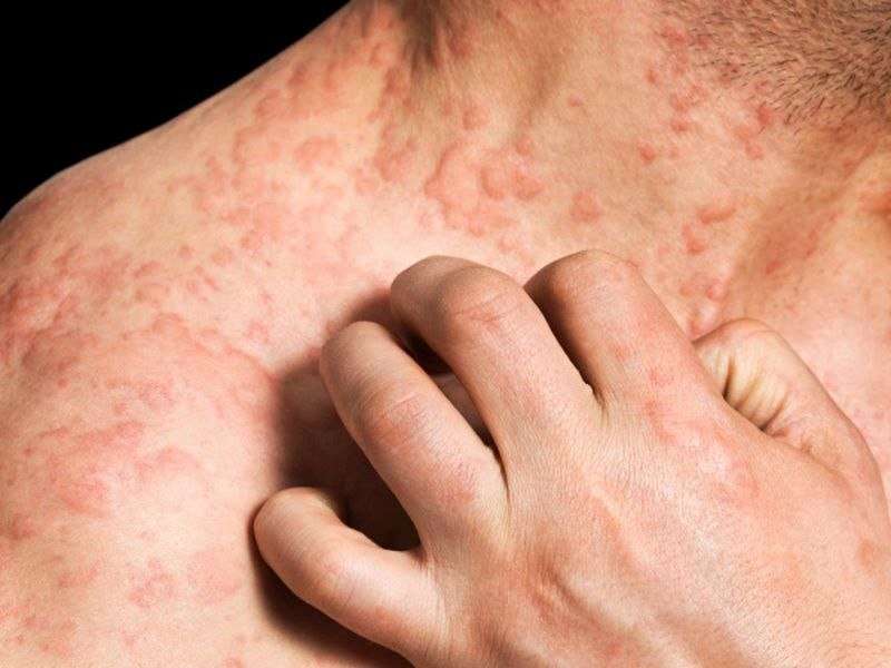 CRP levels potentially useful in chronic spontaneous urticaria 