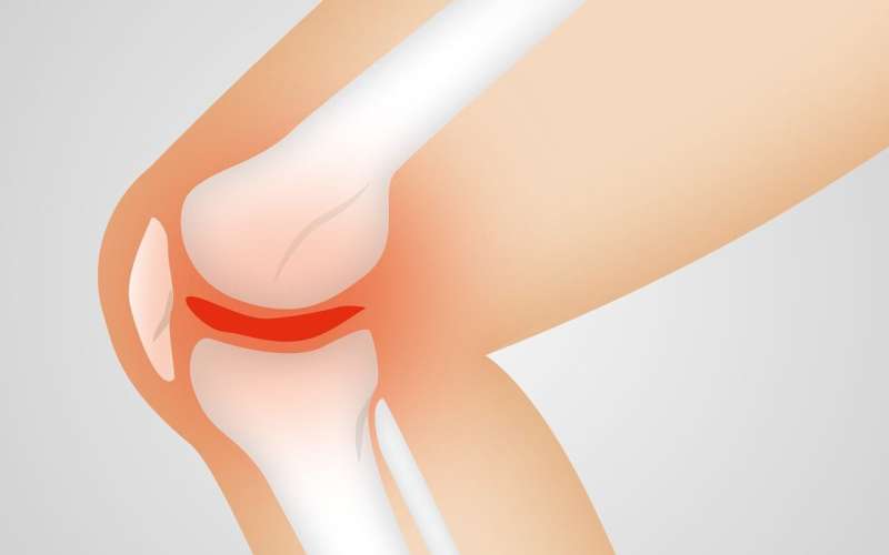 Bone drug may be beneficial for knee osteoarthritis 