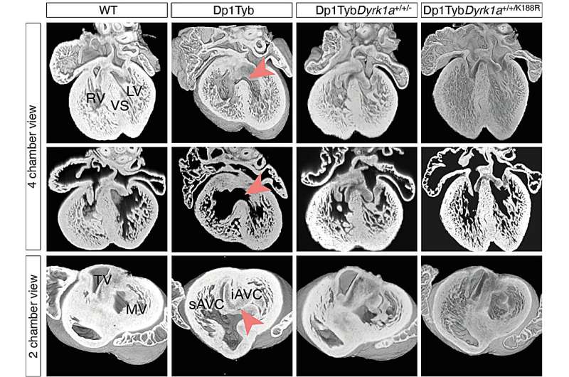 Gene behind heart defects in Down syndrome identified