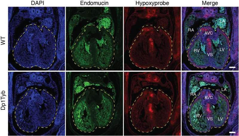 Gene behind heart defects in Down syndrome identified