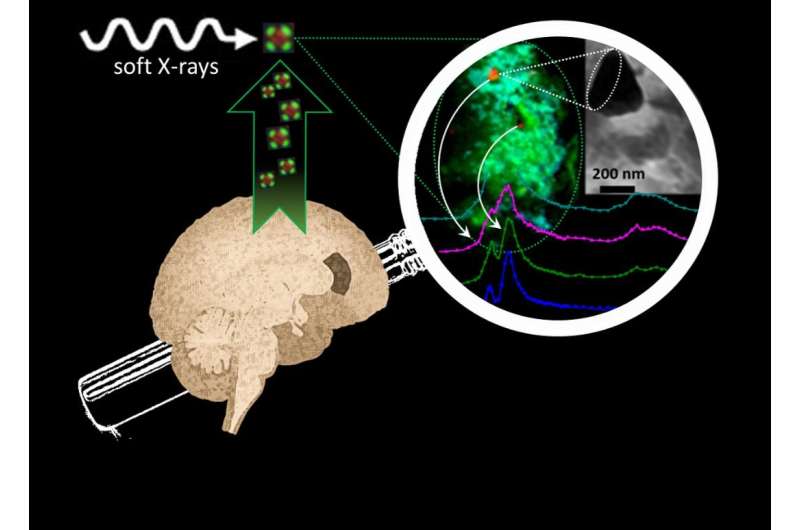 Alzheimer's breakthrough: Brain metals that may drive disease progression revealed