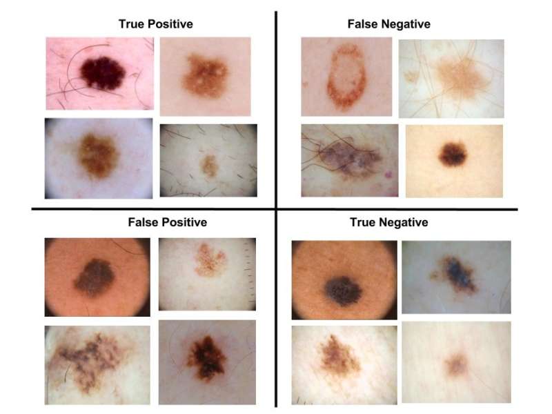 This 'sweet spot' could improve Melanoma diagnosis