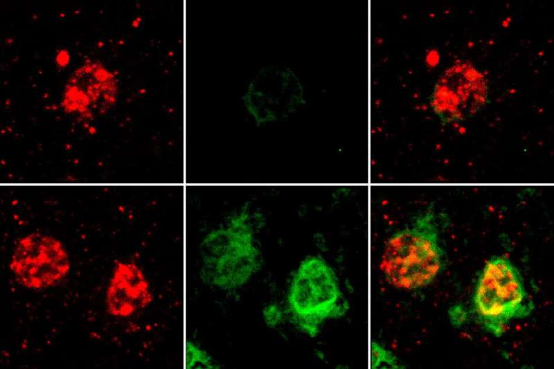 A comprehensive map of how Alzheimer's affects the brain