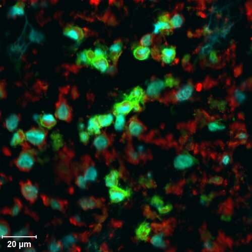 An unexpected developmental hierarchy in an unusual disease 