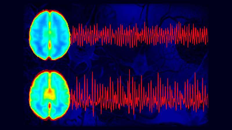 The brain pulsates differently in people suffering from Alzheimer's disease