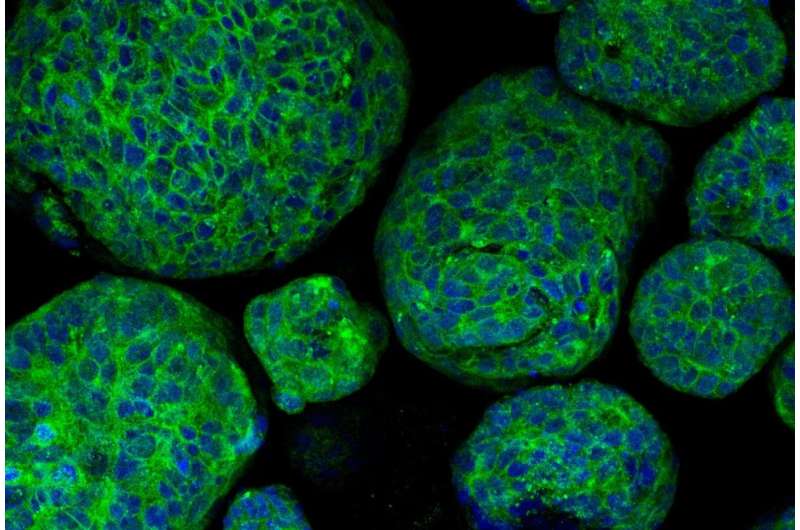 Tumors grown in the lab provide insights on rare prostate cancer 