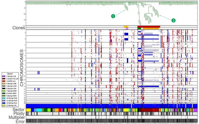 New method to determine before surgery which prostate tumors pose a lethal threat