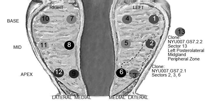 New method to determine before surgery which prostate tumors pose a lethal threat