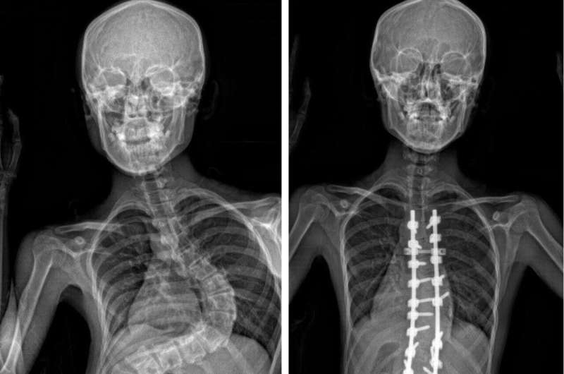 Researchers uncover key genetic clue in adolescent idiopathic scoliosis