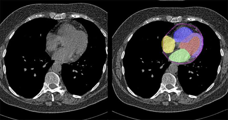 Artificial intelligence can evaluate cardiovascular risk during CT scan