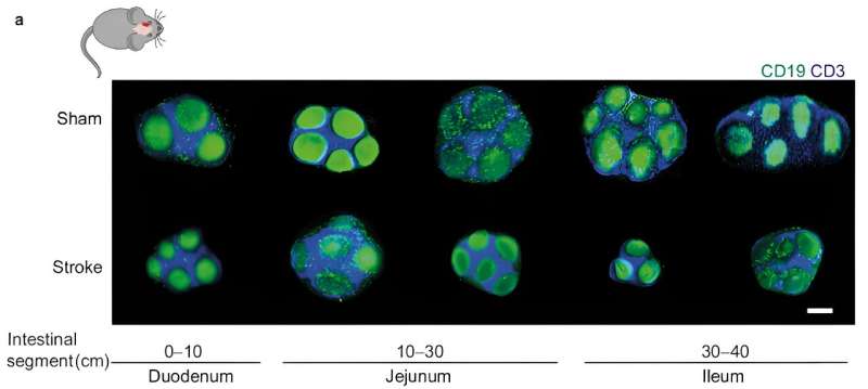 Researchers identify a cause of immunodeficiency after stroke and heart attack