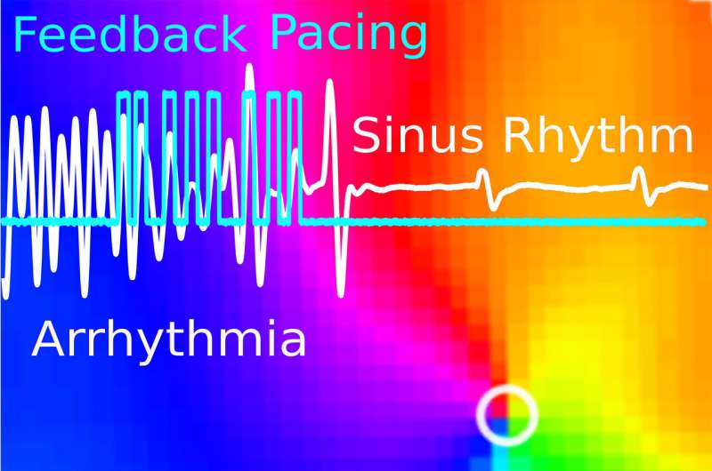 Gentle defibrillation for the heart: A milder method developed by researchers for cardiac arrhythmias