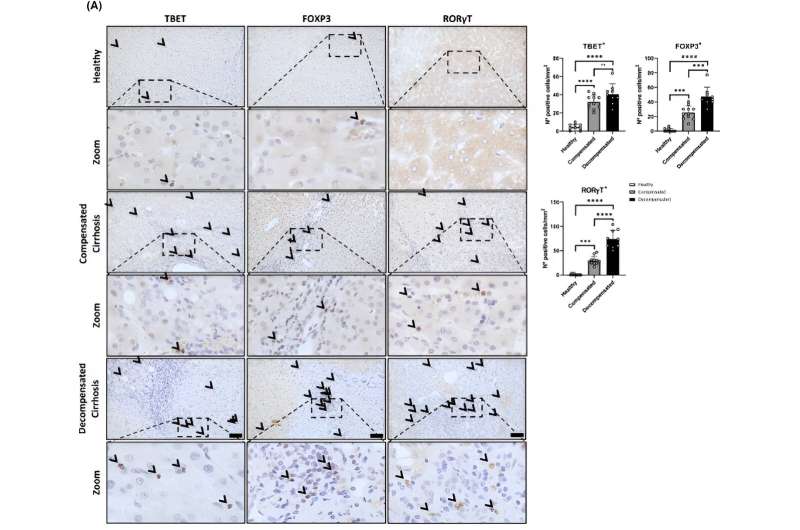 Study advances understanding of liver immune response in cirrhosis