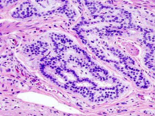 New liquid biopsy test to ID lymph node metastasis in early-stage T1 colorectal cancer 