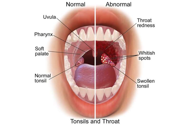 Researchers create model to assess post-tonsillectomy bleed rates 
