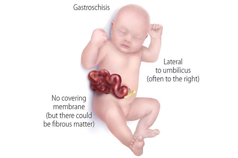 Gastroschisis: A newborn bowel condition that requires specialty care 