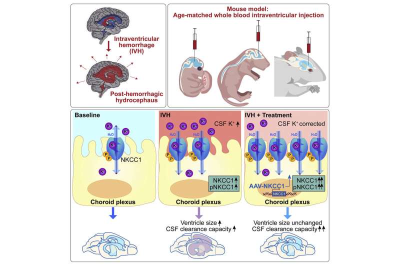 Could gene therapy relieve post-hemorrhagic hydrocephalus?