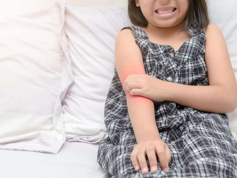 Atopic dermatitis raises subsequent fracture risk in children