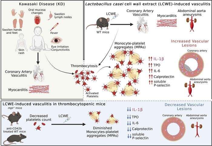 Research reveals blood platelets play important role in Kawasaki disease