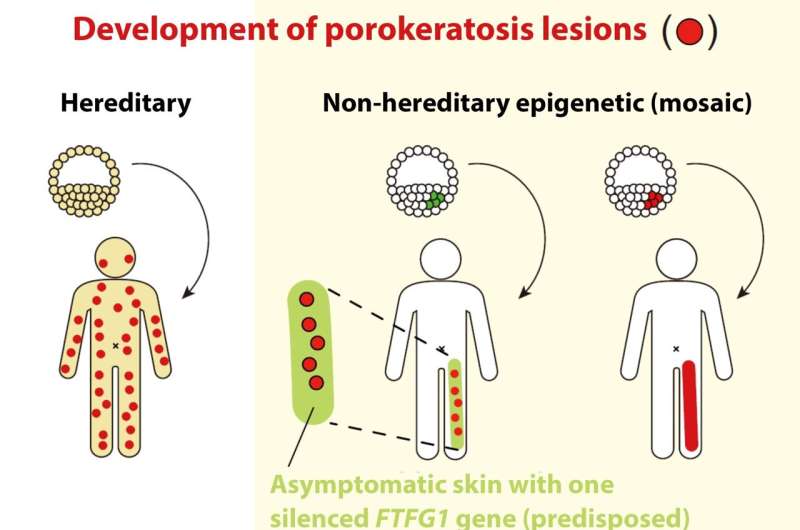 Mosaics of predisposition found to cause skin disease