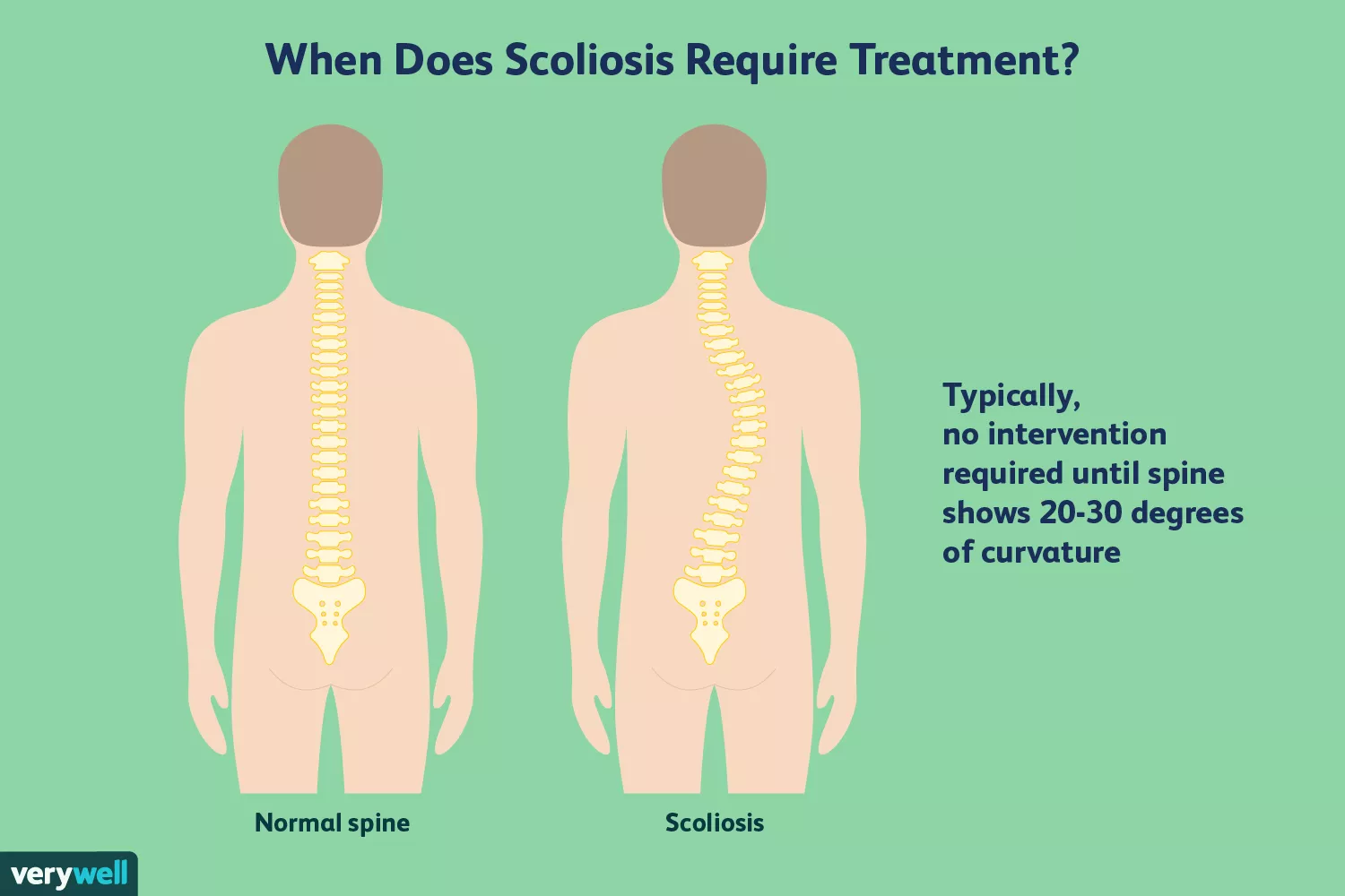 What Is Scoliosis?