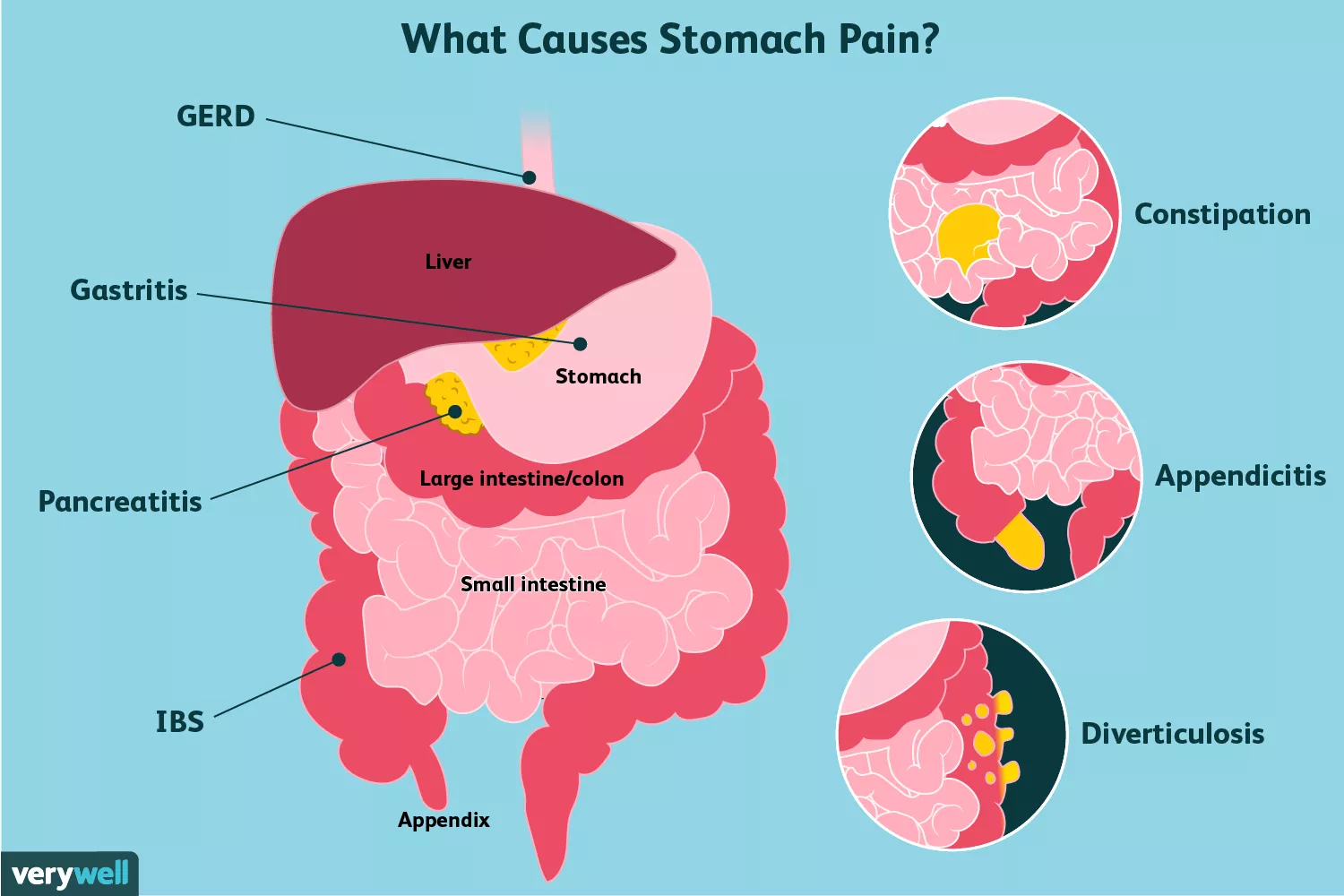 Causes of Stomach Pain and Treatment Options