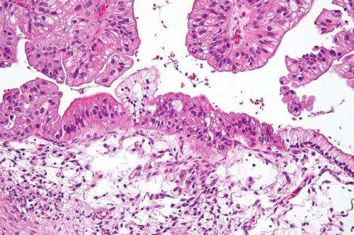 New class of drugs could treat ovarian cancer 