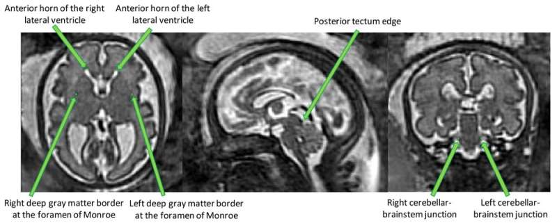 Researchers create first fetal brain atlas for spina bifida aperta 