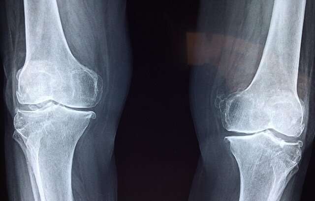 New molecule repairs cartilage and relieves symptoms of osteoarthritis 