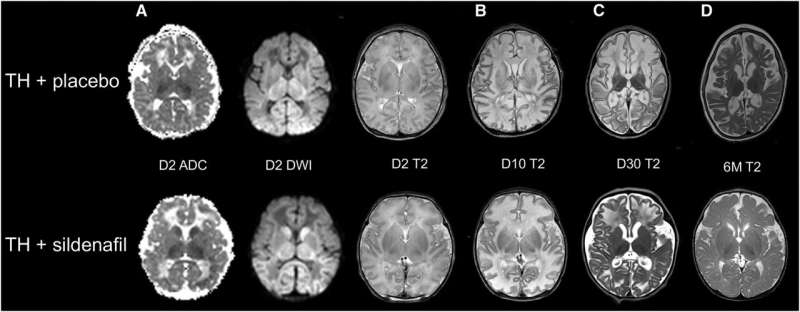 Evolution over time of brain MRI of 2 neonates with NE with severe near-total brain injury despite TH, when treated with TH and placebo (top) and when treated with TH and sildenafil (bottom). A, Day-2 ADC map, diffusion-weighted imaging, and T2-weighted imaging. B, Day-10, C, day-30, and D, 6-month T2-weighted imaging. Both neonates presented with similar brain injuries in basal ganglia, white matter, and cortex at baseline on day 2 of life during TH. Over time, the neonate treated with TH and sildenafil displayed qualitatively less volume loss and less shrinkage of basal ganglia than the neonate treated with TH and placebo. Credit: The Journal of Pediatrics (2023). DOI: 10.1016/j.jpeds.2023.113879